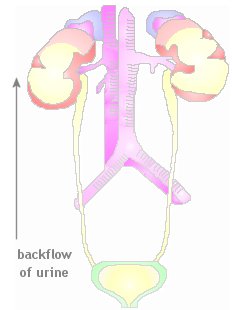 A diagram showing the backflow of urine