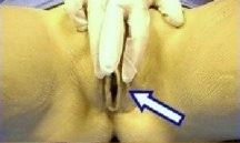 An image of hand spreading the labia open so you can find the urinary opening