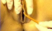 Hand spreading the labia and inserting the catheter