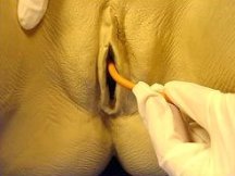 Inserting the catheter slowly and gently in the urinary opening