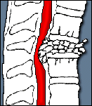 Example of an Incomplete Spinal Cord Injury