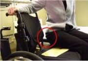 Performing a sliding board transfer incorrectly and rubbing the buttocks over the wheelchair tire